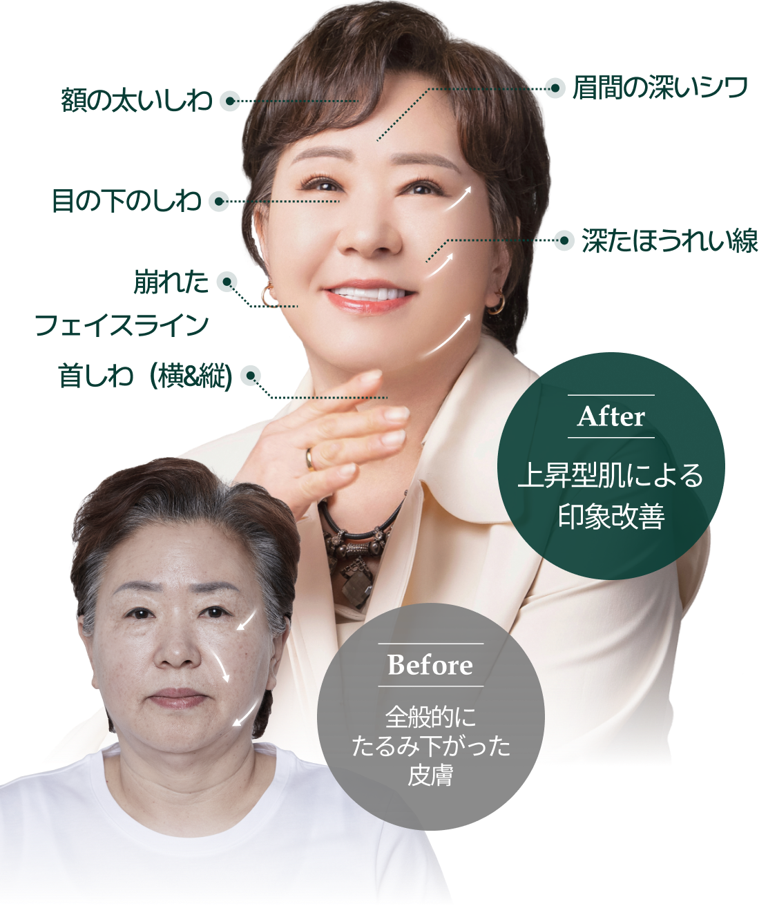 before:全般的に たるみ下がった皮膚, after:上昇型肌による 印象改善