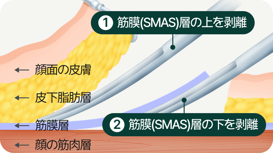 1.筋膜（SMAS）層上の剥離、2.筋膜（SMAS）層下の剥離