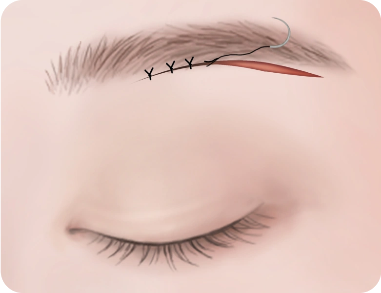 皮膚と上眼瞼挙筋を丁寧に縫合