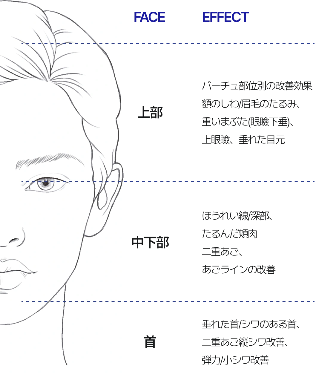 上部（目の周り） : おでこのしわ、眉のたるみ、重いまぶた（眼瞼下垂）、上眼瞼、たるんだ目元 中部・下部（頬周り） : ほうれい線＆深層の頬、たるんだ頬肉、二重あご、あごラインの改善 首 : たるんだ首＆しわのある首、二重あご、縦じわ改善、弾力＆小じわ改善