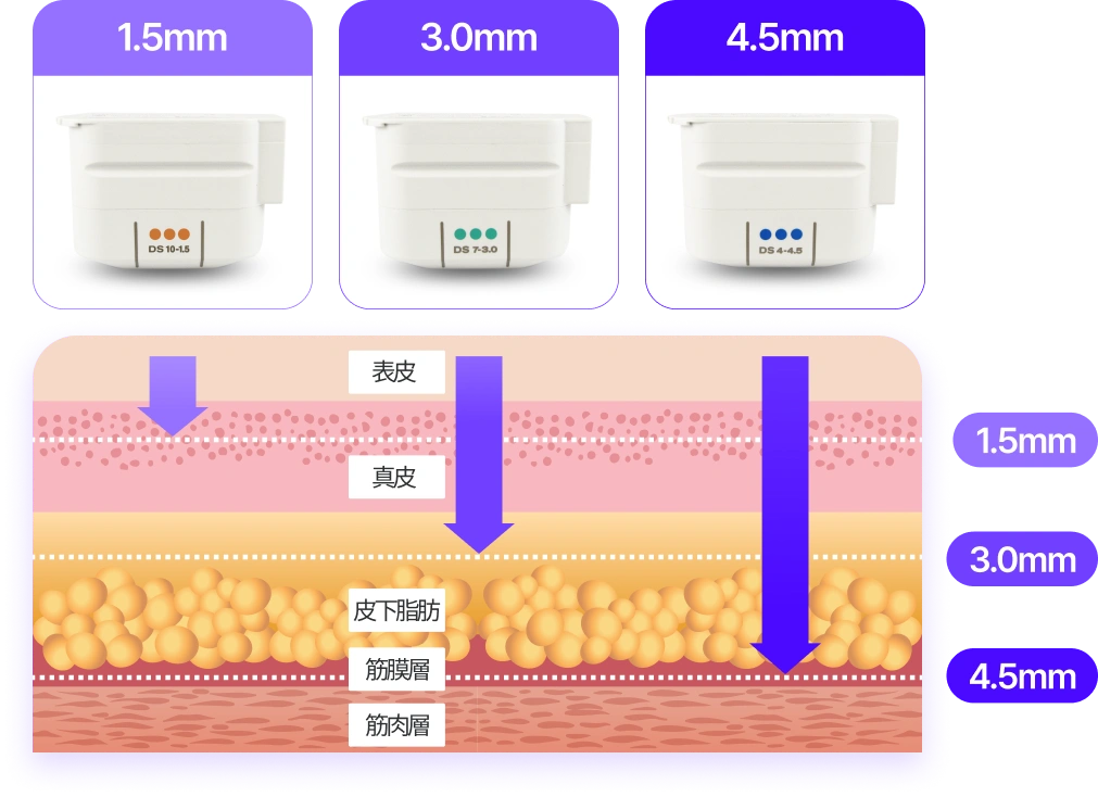 表皮&真皮 : 1.5mm, 皮下脂肪 表層 : 3.0mm, 皮下脂肪 深層&筋膜層&筋肉層 : 4.5mm