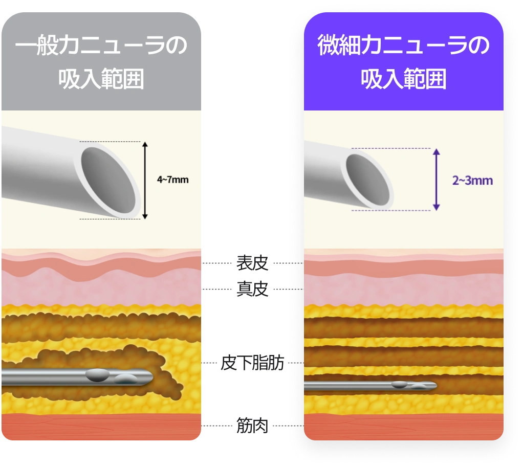 一般カニューラの吸入範囲 : 4~7mm / 微細カニューラの吸入範囲 : 2~3mm(皮下脂肪の損傷が少ない)