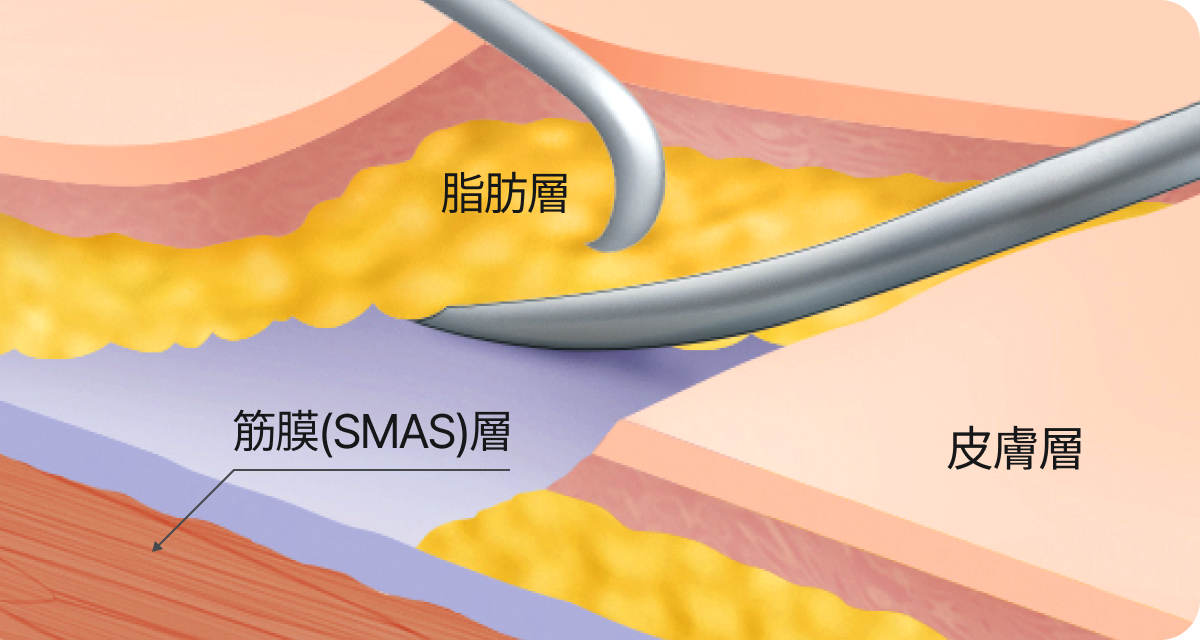 脂肪層を引っ張る正しい剥離方法