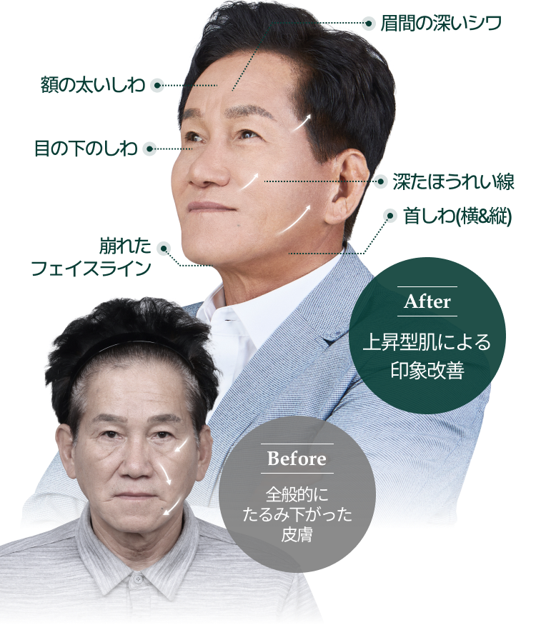 before:全般的に たるみ下がった皮膚, after:上昇型肌による 印象改善