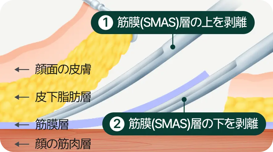 1.筋膜（SMAS）層上の剥離、2.筋膜（SMAS）層下の剥離